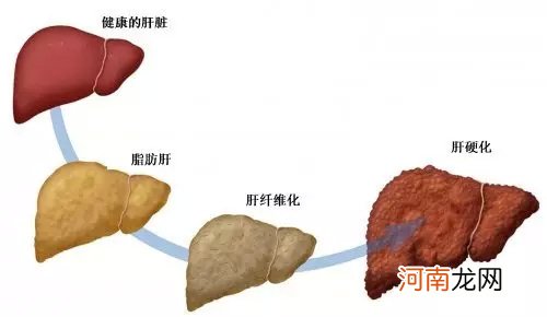 非均质性脂肪肝有点硬