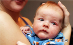 宝宝湿疹的症状图 妈妈必看的宝宝湿疹的最佳治疗方法