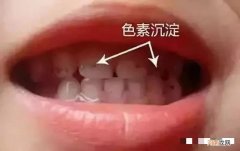 儿童长牙菌斑要处理吗 幼儿牙齿发黑是什么原因引起的