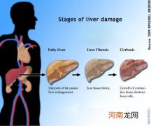 脂肪肝怎么看轻度还是重度