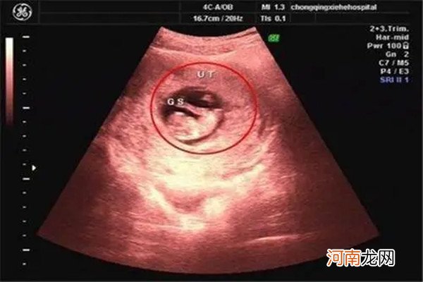 长孕囊和圆孕囊的区别 已生宝妈告诉你答案