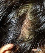 如何改善油性头发 头发油腻得厉害是什么原因造成的