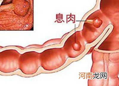 痔疮外痔肉球怎么消除 肛门口有个肉疙瘩是什么