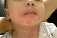 宝宝皮肤瘙痒起红疙瘩 是这几种皮肤疾病在作崇
