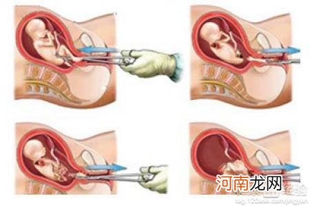 怀孕11周打胎危险吗