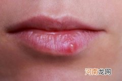 嘴唇上生了一簇密集小水泡 嘴唇上长疱疹是什么原因引起的