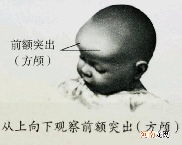 怎样判断宝宝是方头颅 方颅图片和正常对比