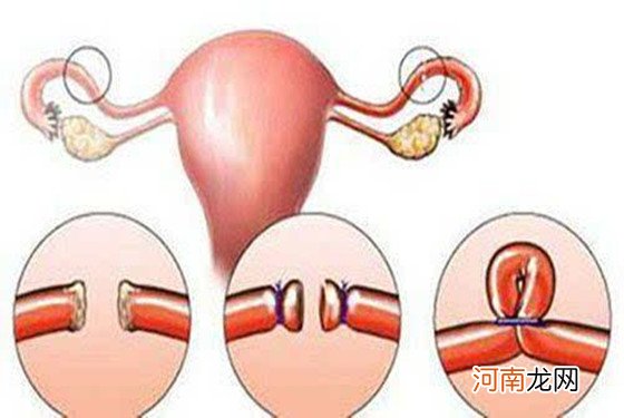 结扎10年了突然怀孕了 听完真相后我直接泪喷