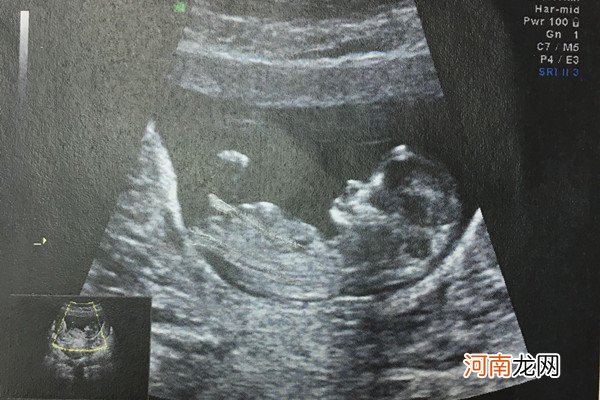 孕13周NT男孩图 怀男孩女孩nt图区别揭秘