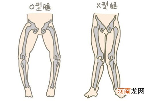 腿是o型腿怎么矫正 o型腿是怎么导致的