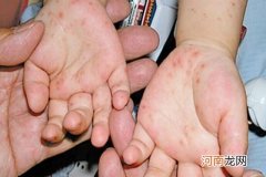 从小儿手足口病图片 看手足口病的初期症状及表现