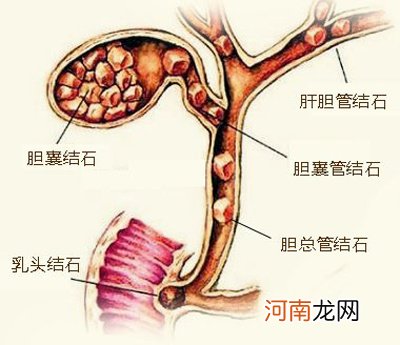 能不能保胆取息肉