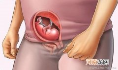 孕吐严重会不会影响胎儿发育