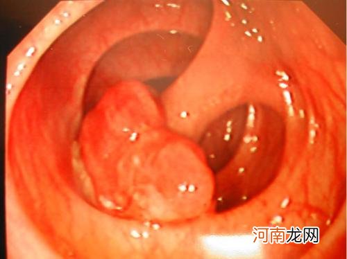 大肠息肉的症状表现 大肠息肉的早期症状