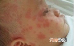 婴幼儿起荨麻疹怎么办 小儿荨麻疹是什么原因引起的