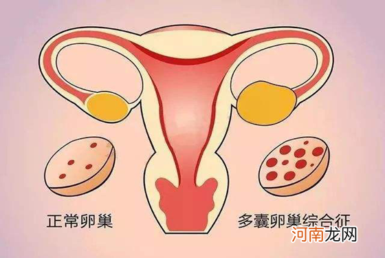 多囊卵巢最快受孕方法 第4种方法最直接了当