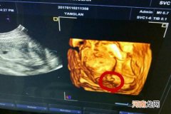 孕12周nt胎儿两腿之间有凸起 这是男宝的性别特征吗