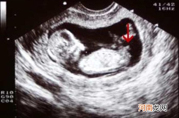 孕12周nt胎儿两腿之间有凸起 这是男宝的性别特征吗
