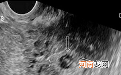 怀孕12周腹痛什么情况