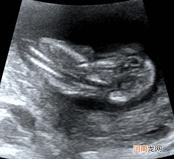怀孕三个月的胎儿是什么样子的 怀孕三个月的胎儿图