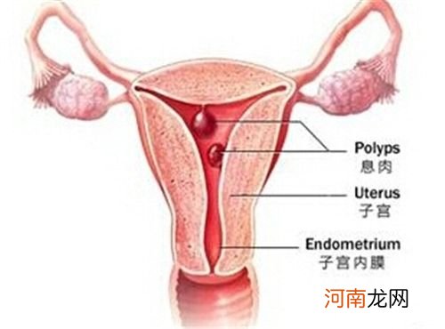 子宫长息肉的原因