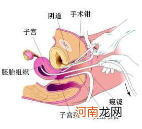 怀孕13周4天能做流产吗