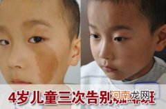 宝宝脸上胎记去除最佳时间 小孩子脸上的胎记能彻底去除吗