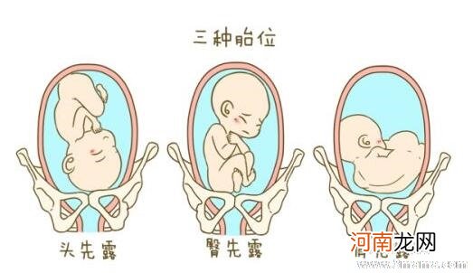 胎儿胎位不正怎么办 什么时候纠正胎位不正最佳