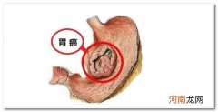 胃癌早期征兆 胃癌的五大早期症状