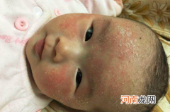 婴儿奶疹是怎么引起的 宝宝脸上长奶癣是什么引起的