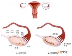 多囊卵巢综合症 多囊卵巢综合症怎么治