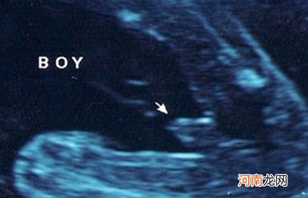 男胎儿小鸡四维显示图 b超图看胎儿性别图解