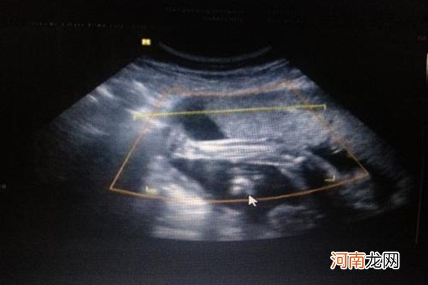 4个月b超说女孩下面平的 四个月女宝器官b超图