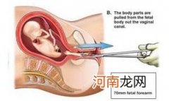 图片 高清实拍：女人堕胎手术全过程 - 顺产