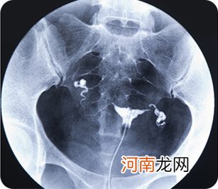 4d无痛输卵管造影价格