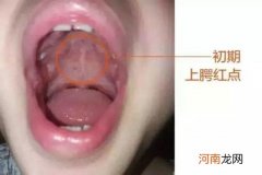 手足口怎么鉴别轻重症有妙计 这5招神管用