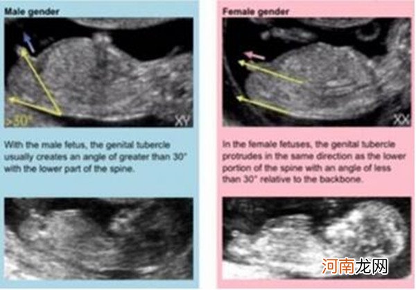 从nt报告单怎么看男女 nt图看男女已生验证