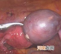 子宫肌瘤会影响受孕吗