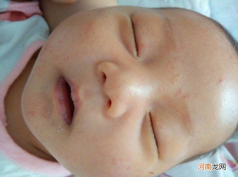 宝宝脸上红点点是什么 婴儿脸上有小红疙瘩怎么办