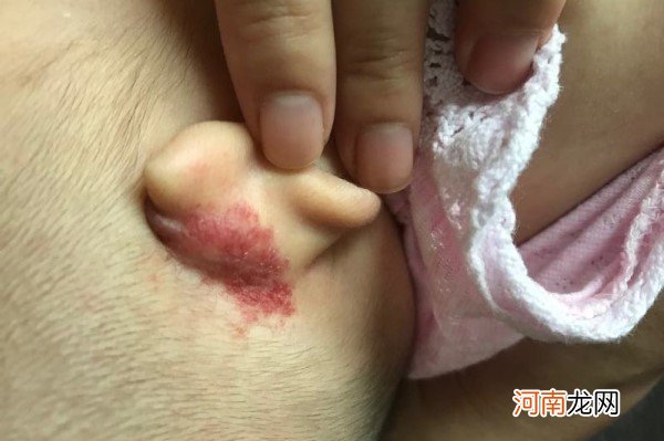 宝宝血管瘤怎么治疗 婴儿血管瘤怎么治疗最好