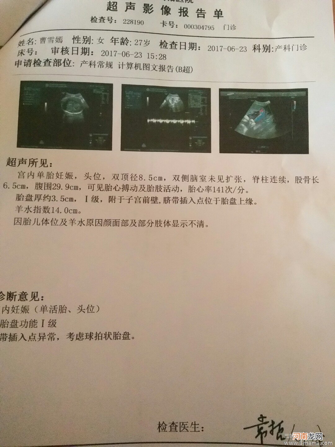 球拍状胎盘顺产成功率