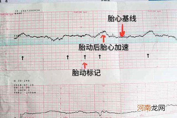 nt胎心率160绝对是女孩 胎心看男女准吗