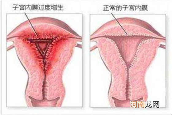 子宫内膜厚怎么回事 子宫内膜增厚如何治疗？