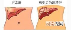 酒精性肝病能治好吗