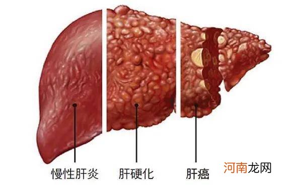 治疗肝硬化一月多少钱