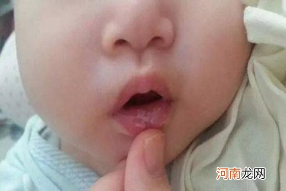 婴儿鹅口疮最早期图片还真和奶苔差不多 注意别治错