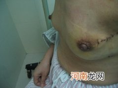 三十岁后生育易患乳腺癌的