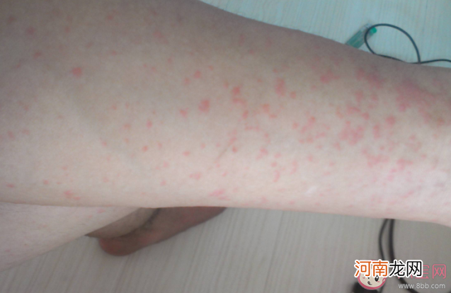 湿疹|长湿疹是不是要少洗澡 得了湿疹生活中应该注意什么
