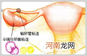 输卵管粘连怎么办最好