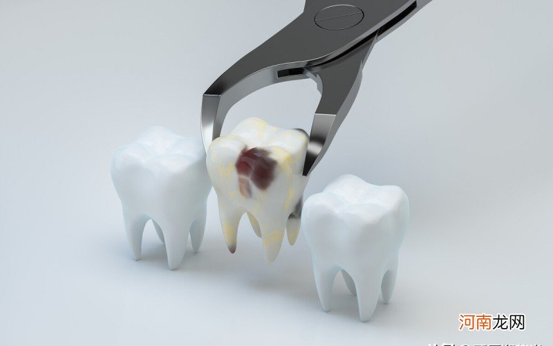 拔完智齿几天能恢复 拔牙几天后可以恢复正常饮食